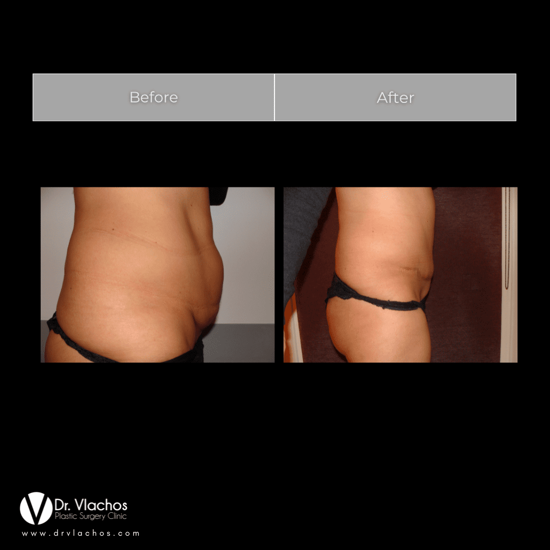 Κοιλιοπλαστική 