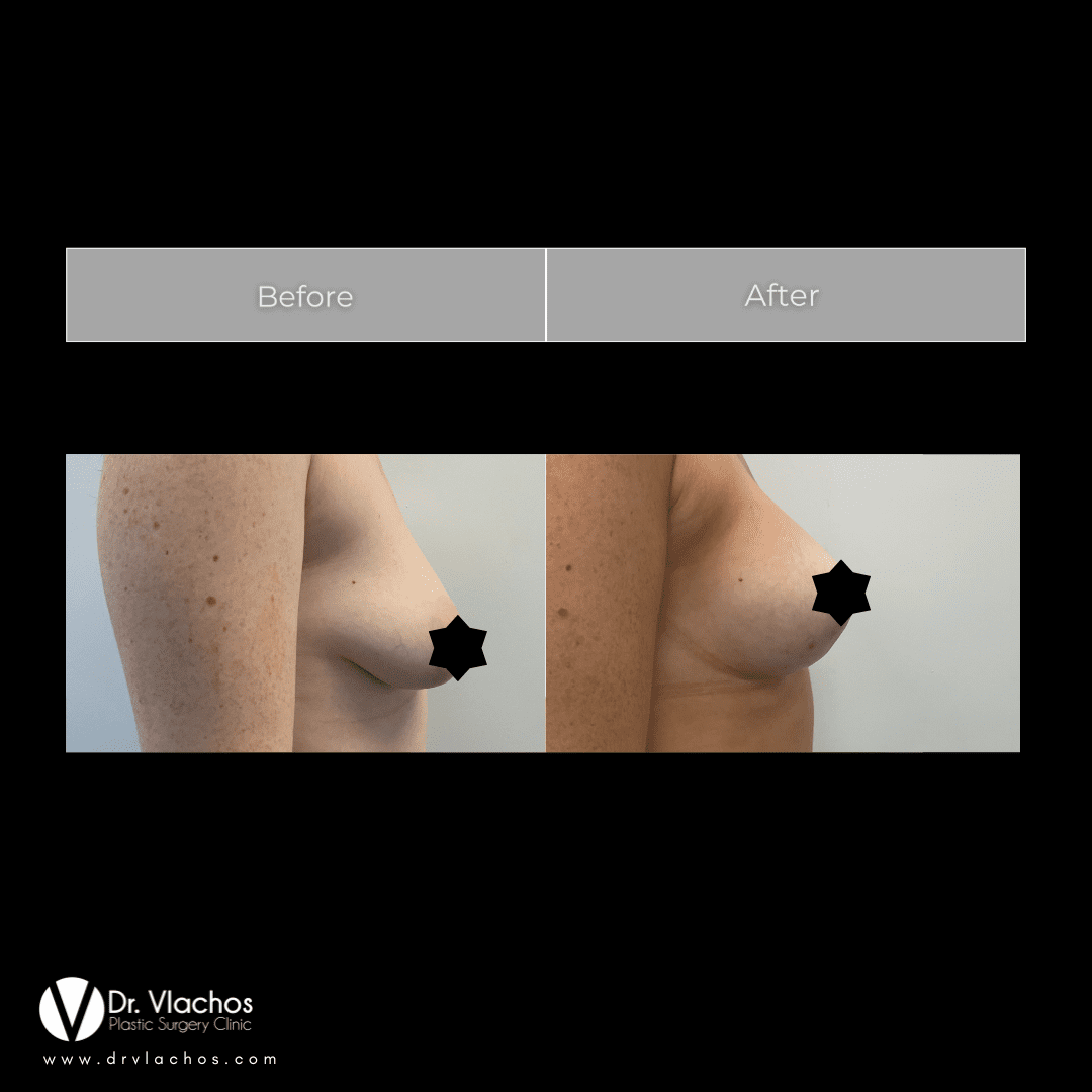 Επεμβάσεις στήθους