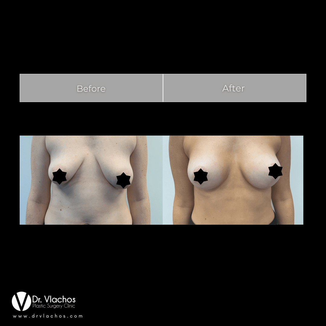 Επεμβάσεις στήθους